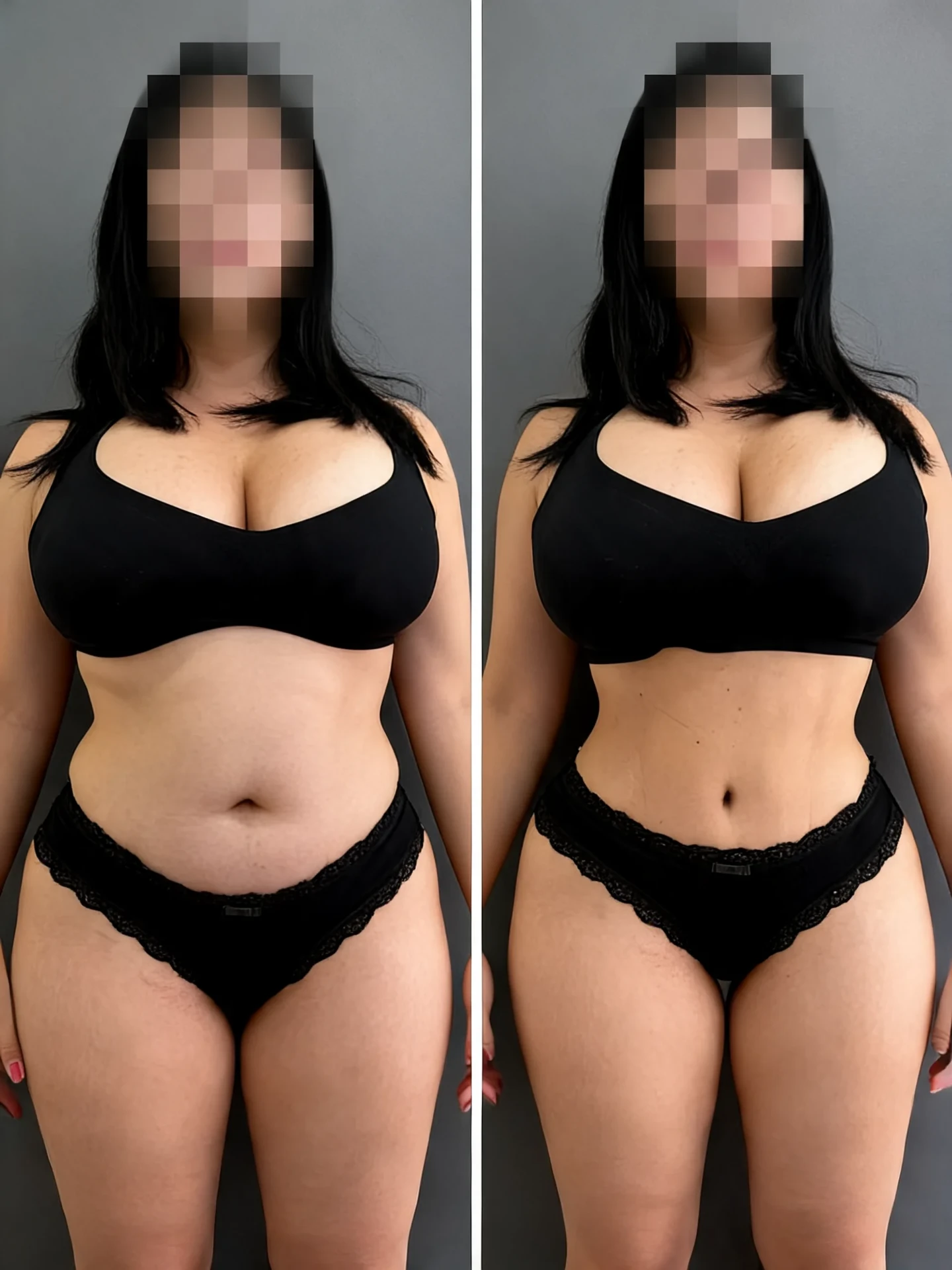 Antes y después · Abdominoplastia HD