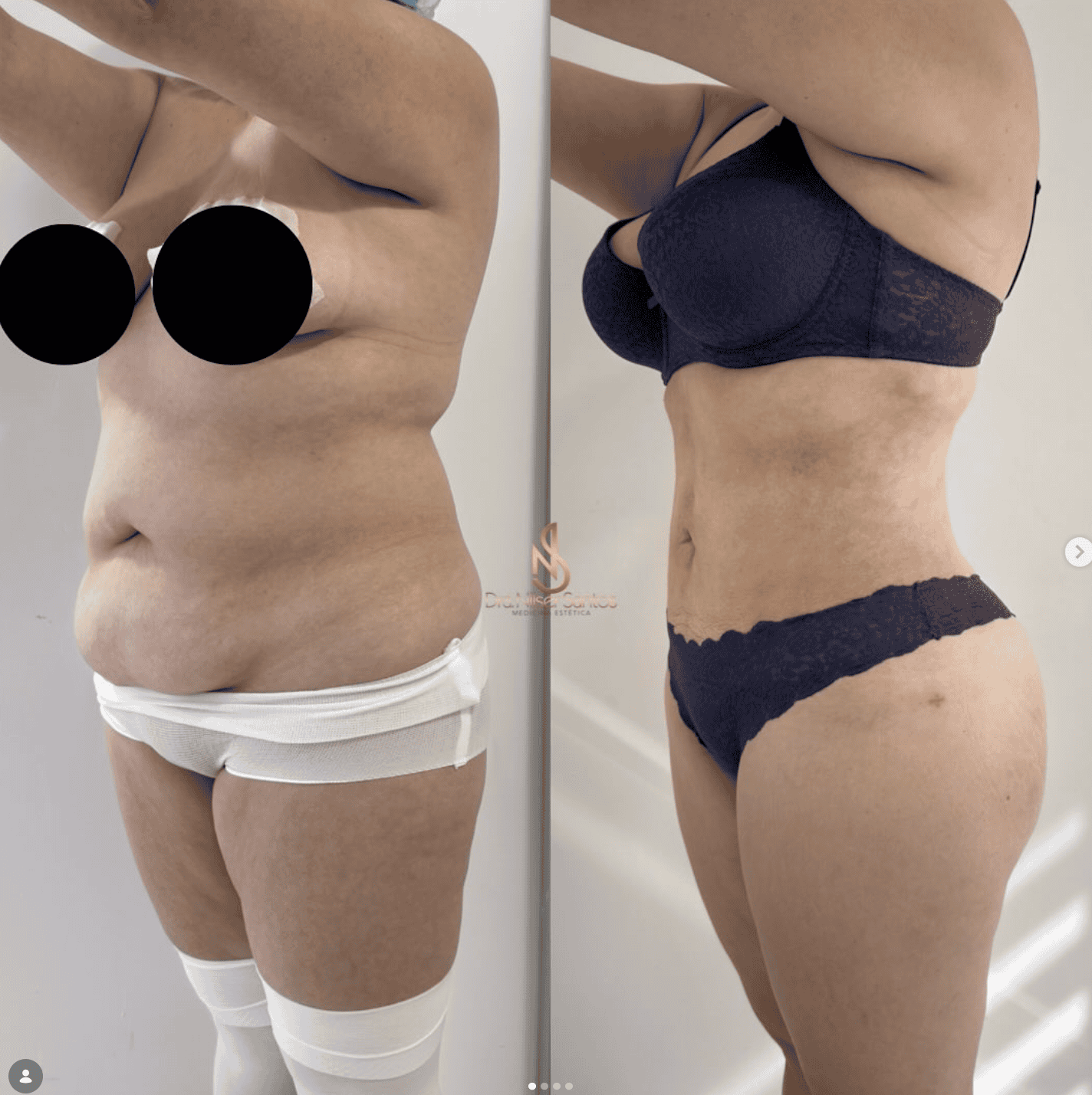 Antes y después · Lipo Vaser · Vista lateral