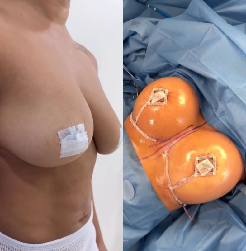 Antes y después · Mastopexia con implante mamario